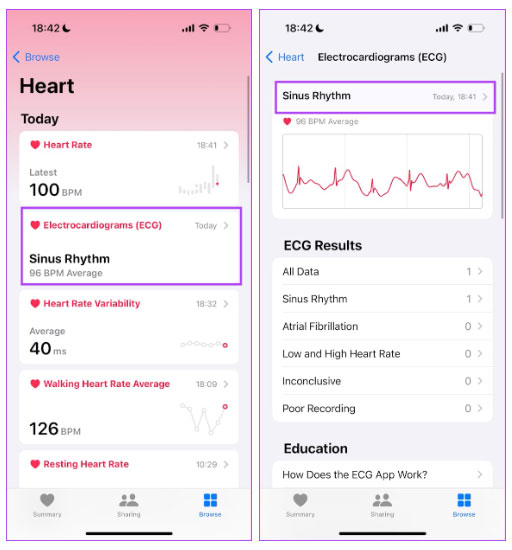 Kết quả ECG